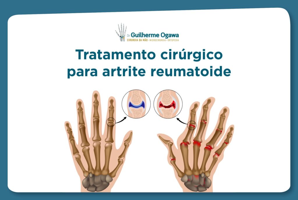 tratamento cirúrgico para artrite reumatoide