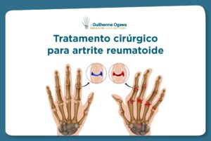 tratamento cirúrgico para artrite reumatoide